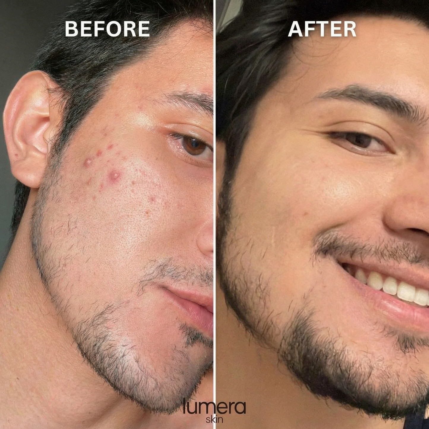 Lumera® Alaska Volcano Pore Clay Stick
